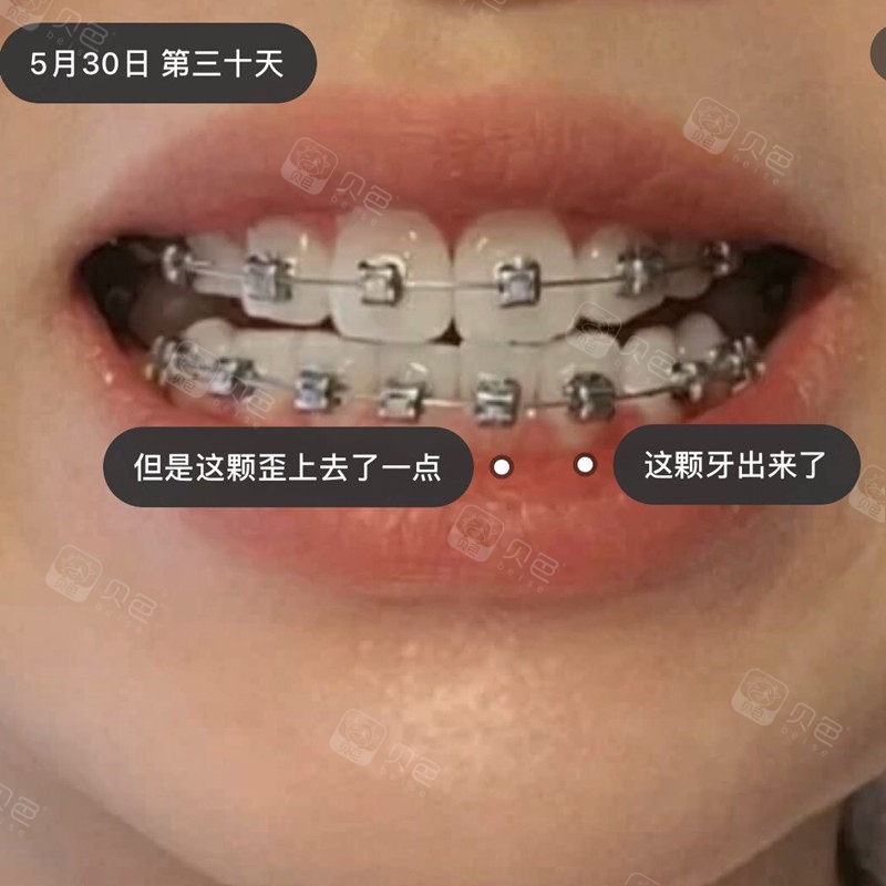 晒晒我带金属自锁牙套的流程还有30天对比照