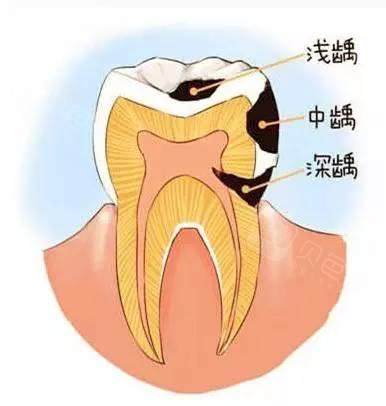 龋齿几年都不痛是不是就不用补 为什么深龋千万不要去