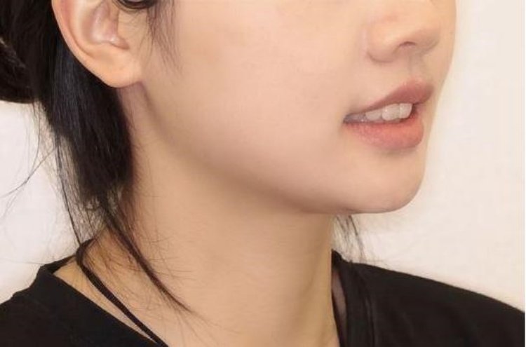 💫23岁龅牙女孩隐形矫正全记录｜从"凸嘴妹"到"侧颜杀"的逆袭之路案例图片 4
