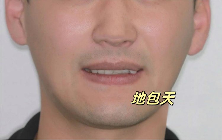 28岁地包天男孩自救指南｜隐形矫正让我从自卑到被夸"换头"案例图片 4