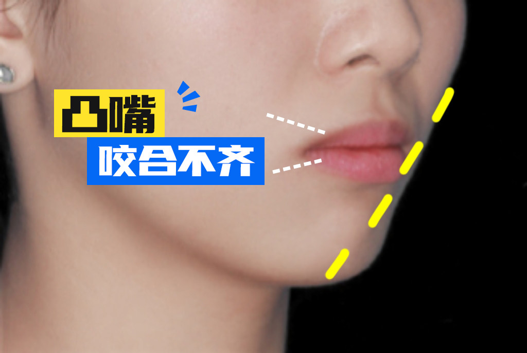 牙齿矫正1年｜告别咬合不齐的干货分享！ 😆