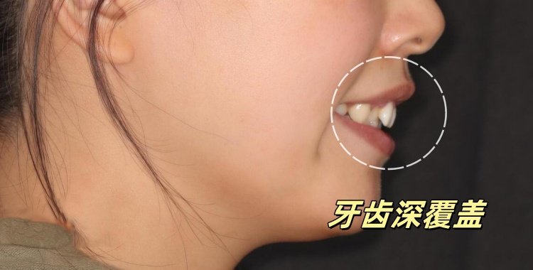 27岁深覆盖女孩矫正&mdash;&mdash;笑出强大真的会转运！案例图片 2