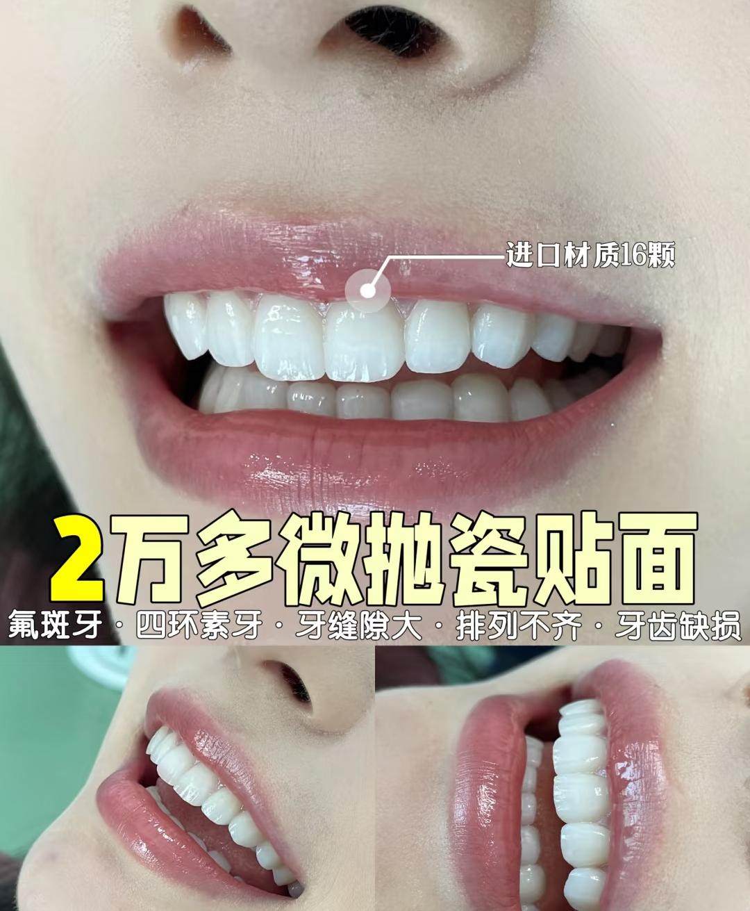 2W+微抛瓷贴面真实分享｜氟斑牙+牙缝大逆袭日记案例图片 1