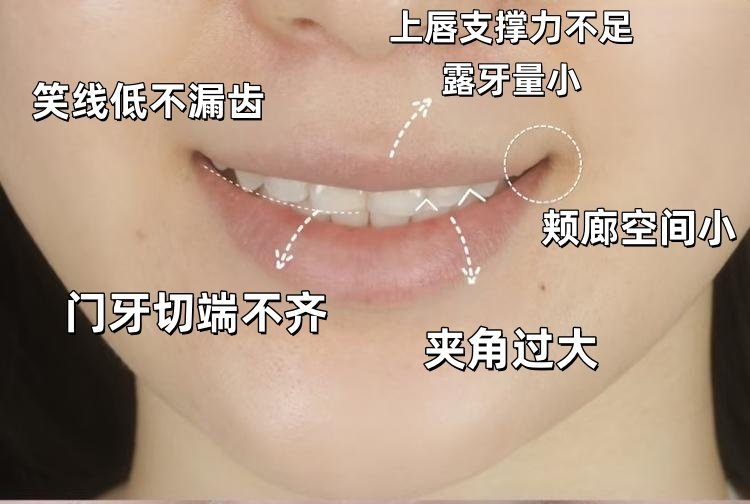 从"尴尬笑"到"钻石笑"！我的美学贴面逆袭日记案例图片 2