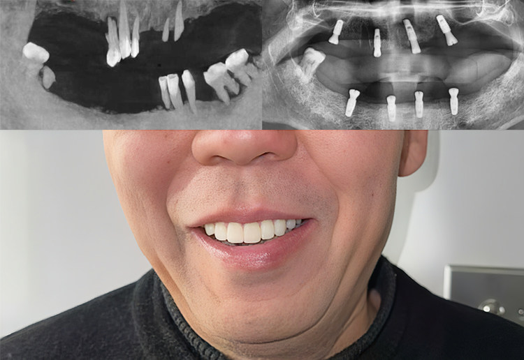 🦷从"铁齿铜牙"到"真香"的逆袭之路案例图片 2