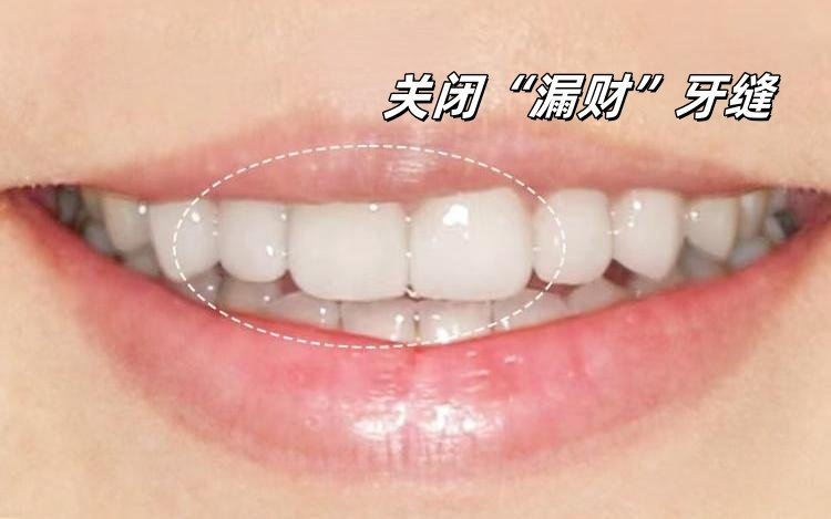 🦷从"尴尬露齿笑"到"人间水蜜桃"的变美小心机案例图片 3