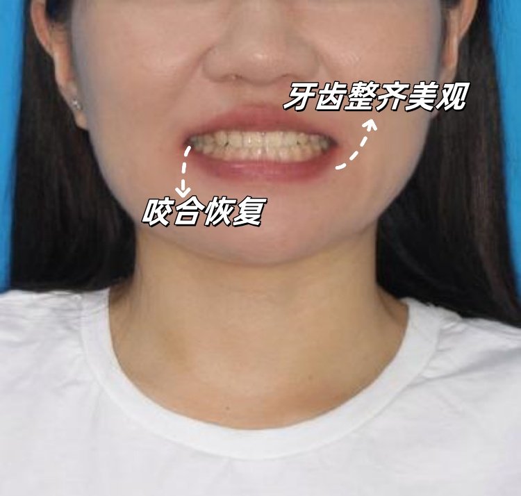 🌸我的隐形矫正全记录｜从自卑到自信的逆袭之路案例图片 2