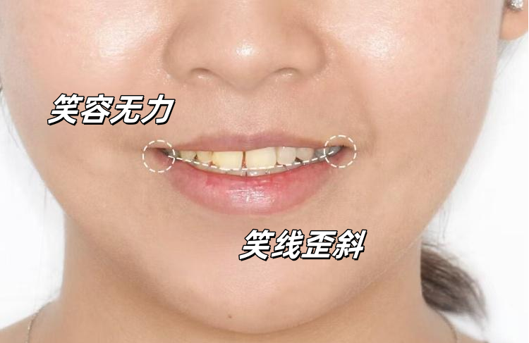 💎牙齿贴面两年记｜从黄牙妹到人间水蜜桃的逆袭秘籍案例图片 2