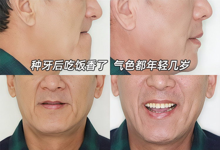 带65岁老爸种牙全记录｜从抗拒到真香的孝心之旅