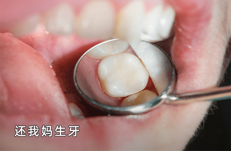 拖延症患者含泪总结：补牙真的越早越好！我的血泪史+避坑指南案例图片 3