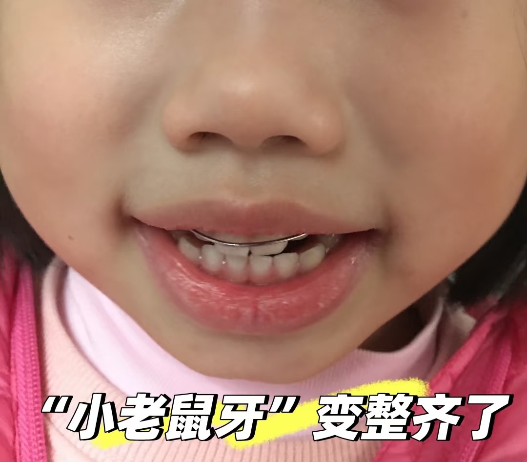 🐭✨从&ldquo;小老鼠牙&rdquo;到整整齐齐，老母亲终于放心了！