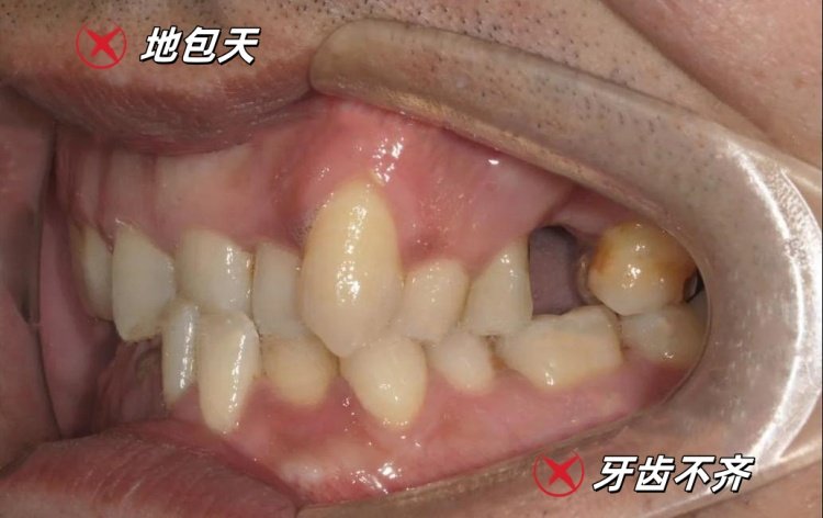 28岁地包天男孩自救指南｜隐形矫正让我从自卑到被夸"换头"案例图片 2