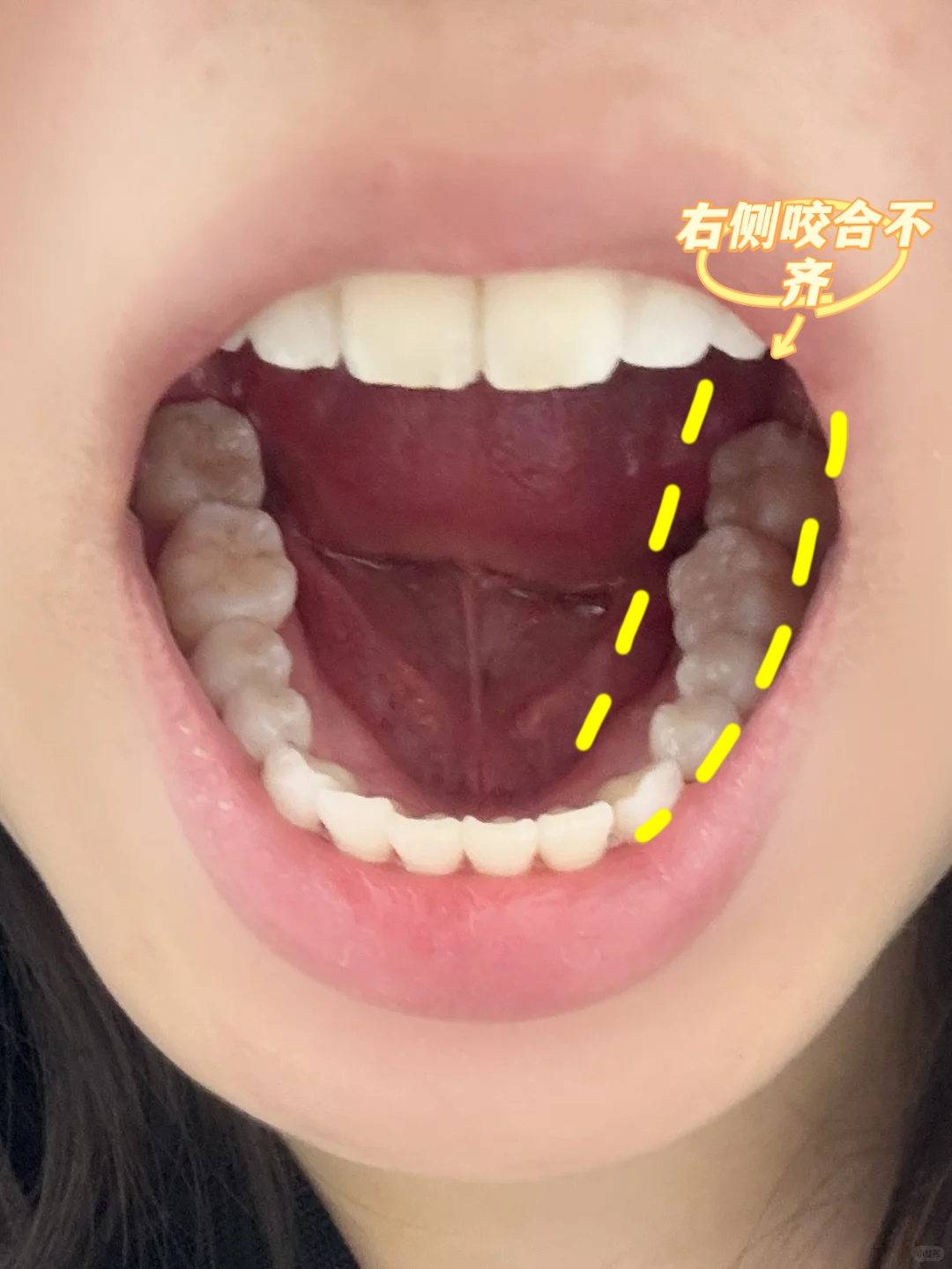 中线不齐矫正分享 告别歪牙尴尬！🌟案例图片 2