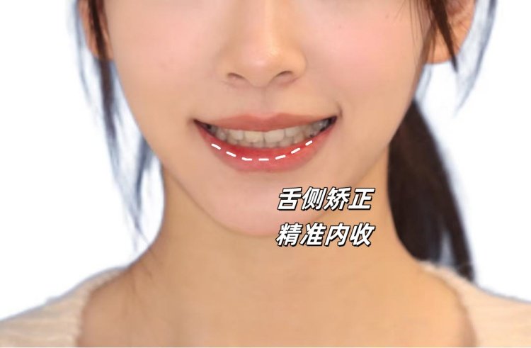 从"钢牙妹"到"隐形美人"｜我的5.8万舌侧矫正血泪史