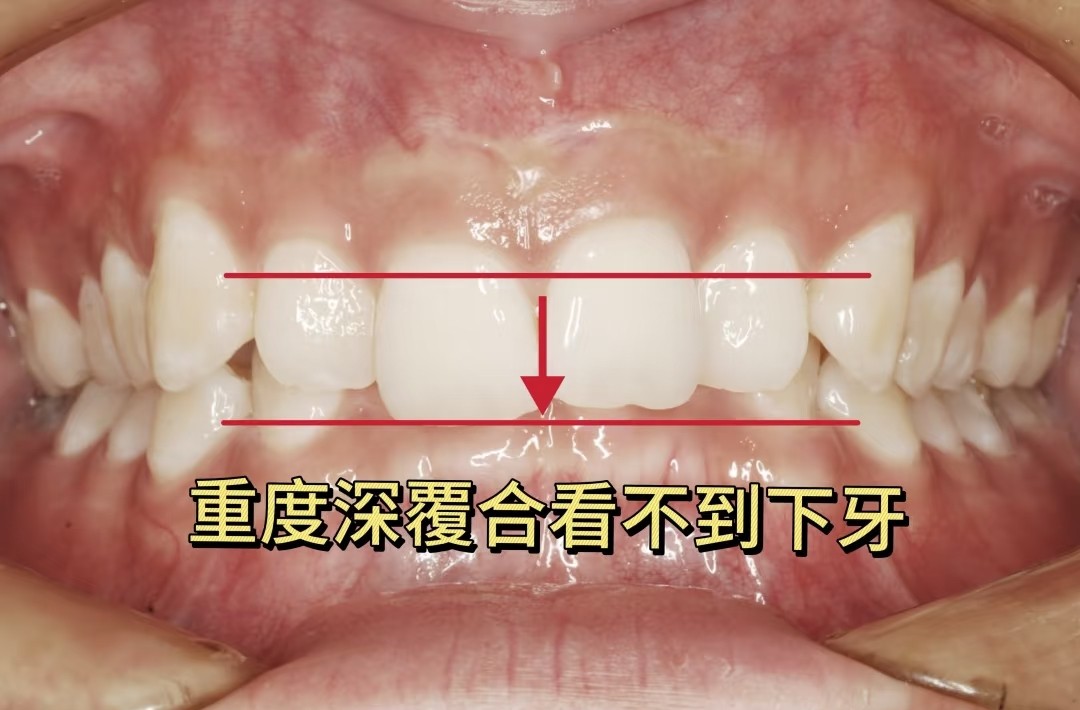 重度深覆合自救指南！看不到下牙也能逆袭微笑线！ ✨案例图片 2