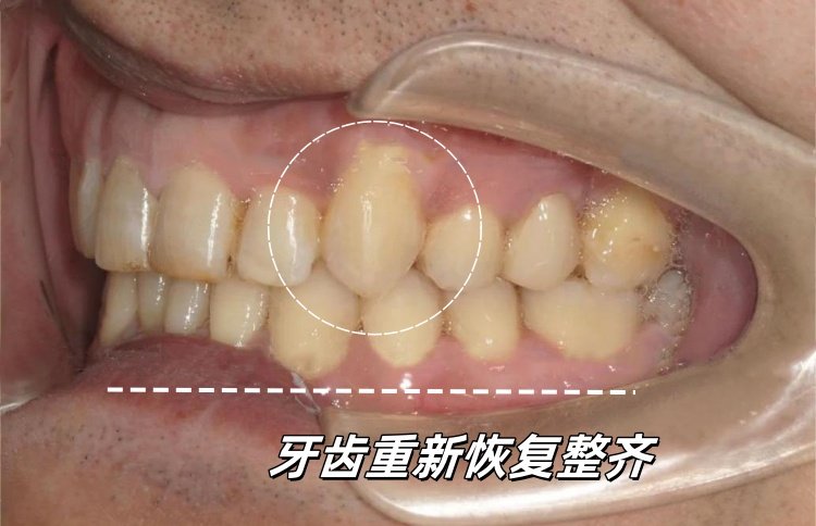 28岁地包天男孩自救指南｜隐形矫正让我从自卑到被夸"换头"案例图片 3