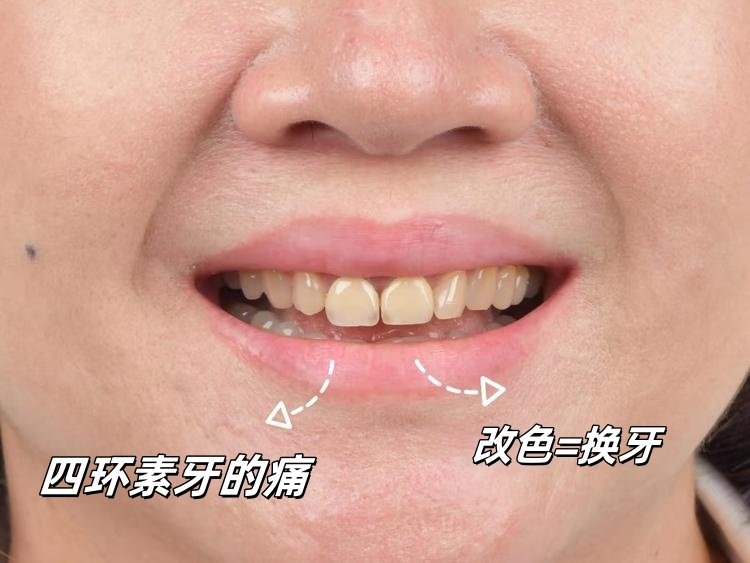 牙齿贴面全记录｜黄牙+歪牙逆袭"笑容自由"的变美指南案例图片 2
