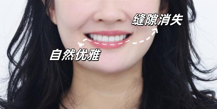 26岁牙套女孩的黑三角自救记｜从&ldquo;漏风笑&rdquo;到&ldquo;妈生感笑线&rdquo;的逆袭全记录