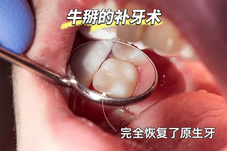 补牙经历分享｜医生夸我保养意识好！🦷