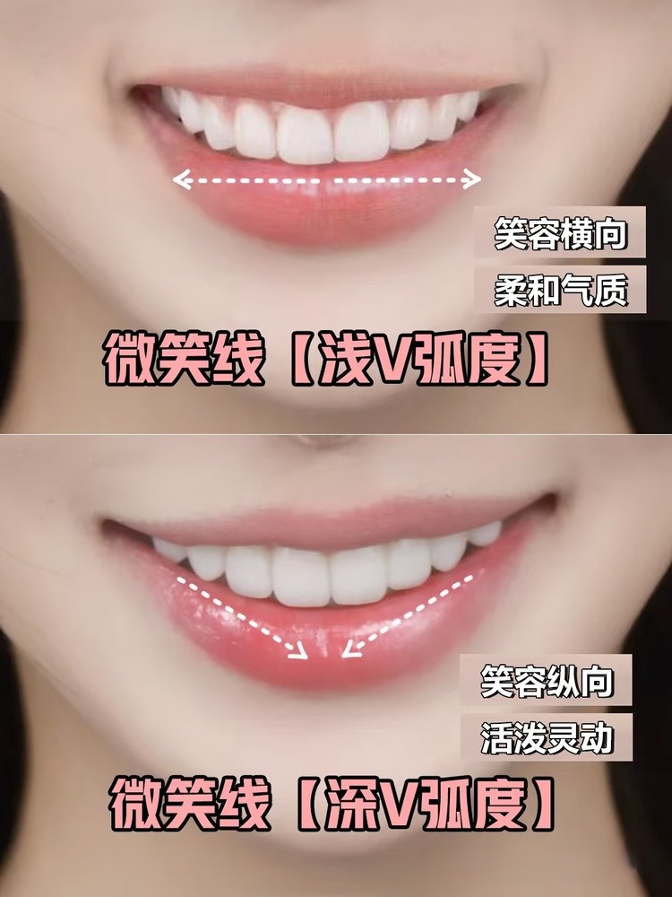 牙贴面风格大揭秘｜少女感VS高智感你pick哪款？案例图片 1