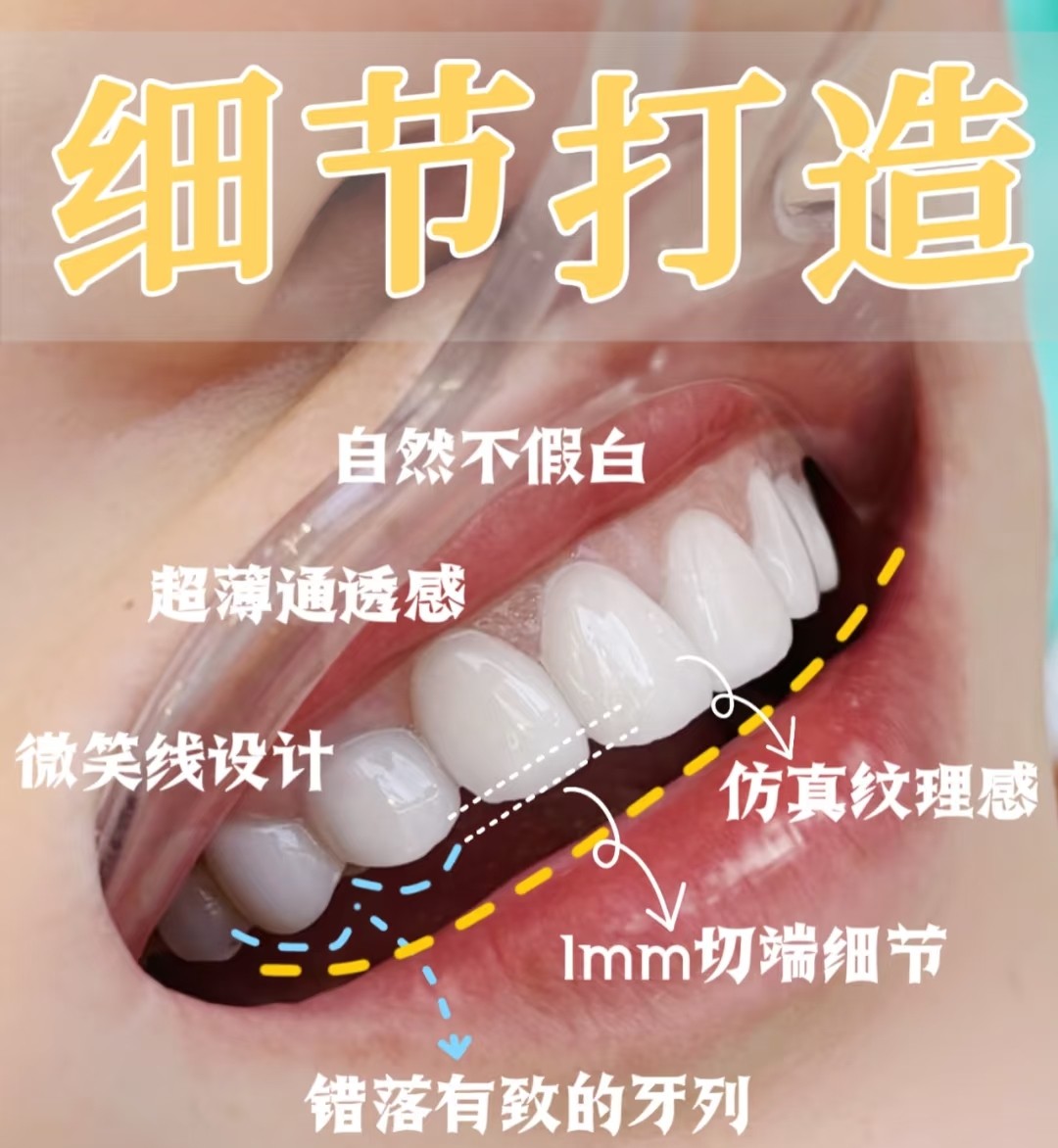 🍬我的牙齿美白贴面改造日记｜细节分享+真实效果案例图片 1