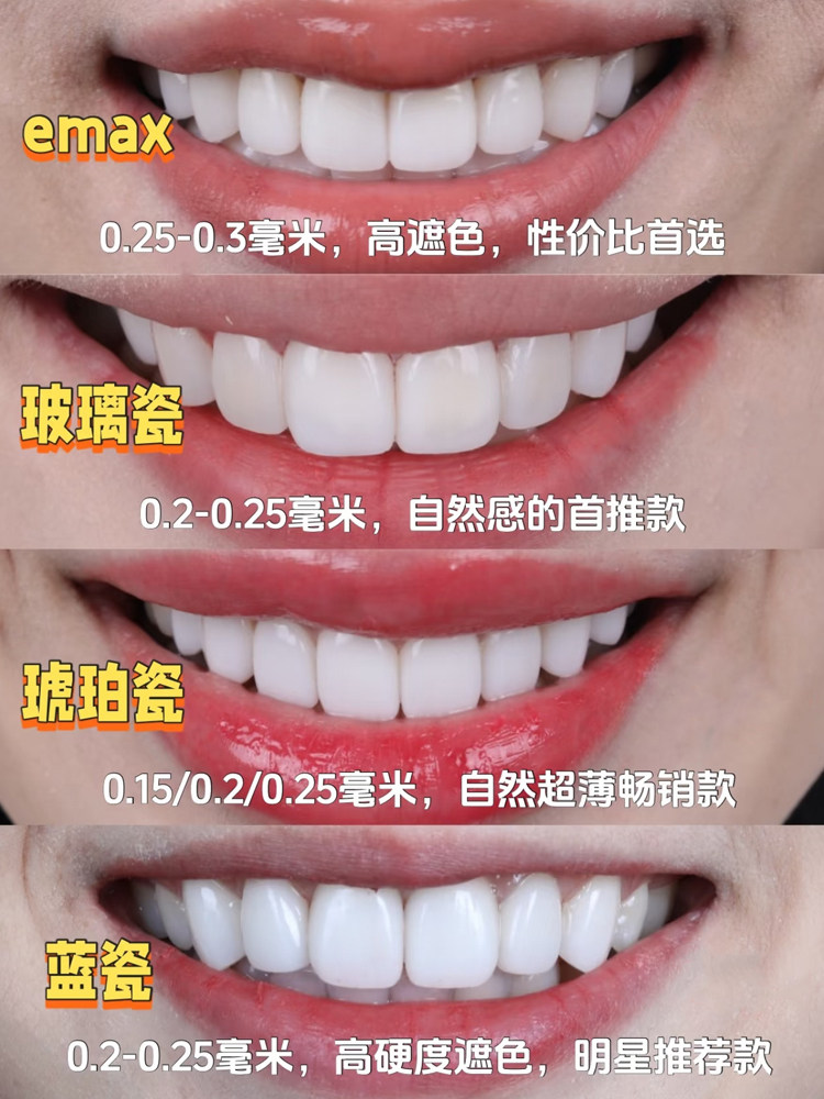 众说纷纭的牙贴面材料，哪个是你的心头爱！案例图片 2