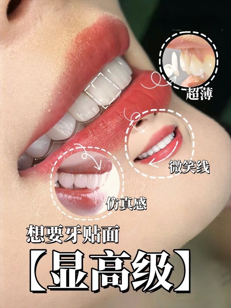 牙贴面两年真实反馈｜3W换来的血泪经验！低价贴面真的香吗？案例图片 1