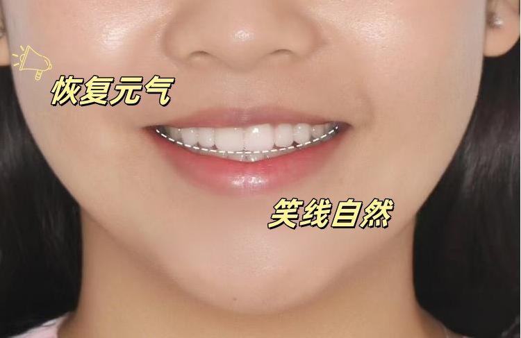 💎牙齿贴面两年记｜从黄牙妹到人间水蜜桃的逆袭秘籍