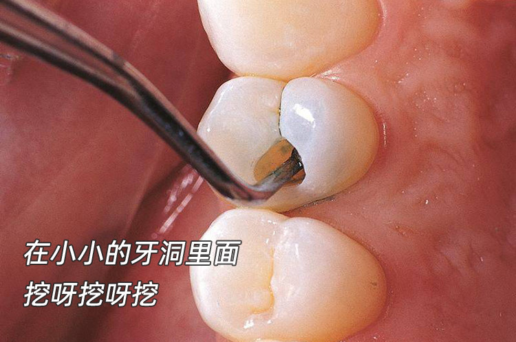 补牙经历分享｜医生夸我保养意识好！🦷案例图片 2