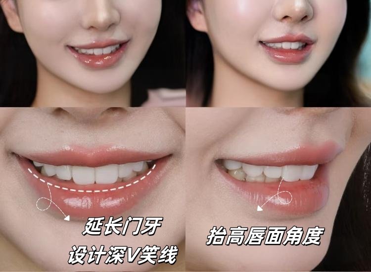 🔥牙齿不齐的姐妹看过来！不用磨牙也能拥有完美笑线