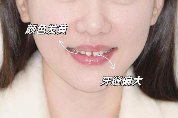 ✨后悔没早做的变美秘籍｜牙贴面初体验全记录！案例图片 2