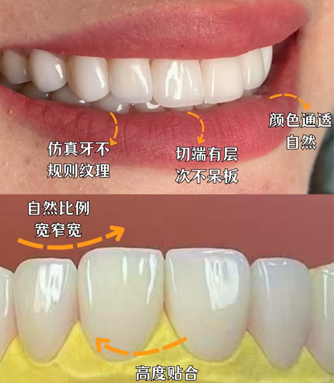💎【妈生牙贴面实测】牙齿秒变&ldquo;玻璃瓷&rdquo;，素颜也能美到发光！💎✨案例图片 2