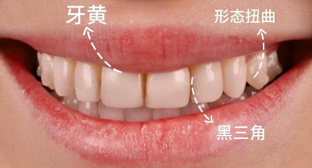 牙齿缝隙填补神器！让瑕疵秒变高级感✨案例图片 2