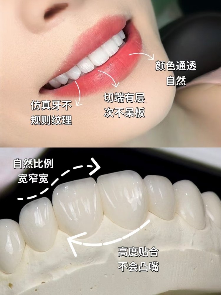 牙贴面两年真实反馈｜3W换来的血泪经验！低价贴面真的香吗？案例图片 2