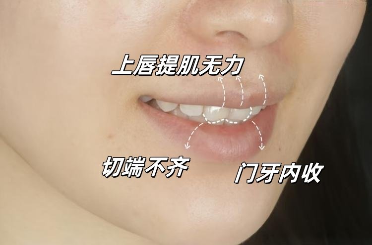 从"尴尬笑"到"钻石笑"！我的美学贴面逆袭日记案例图片 3