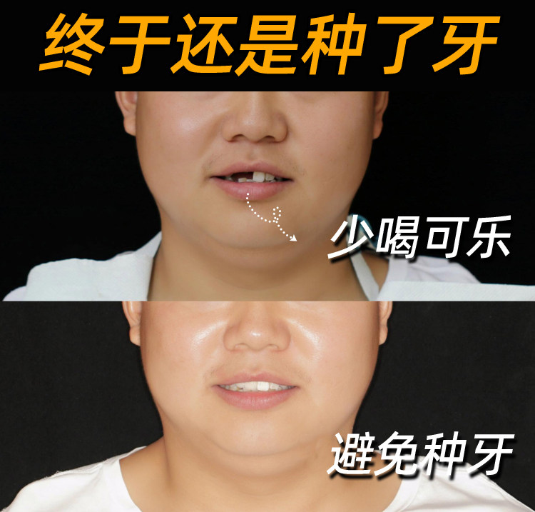 可乐当水喝？38岁老哥的种牙血泪史！男生们听劝！案例图片 1