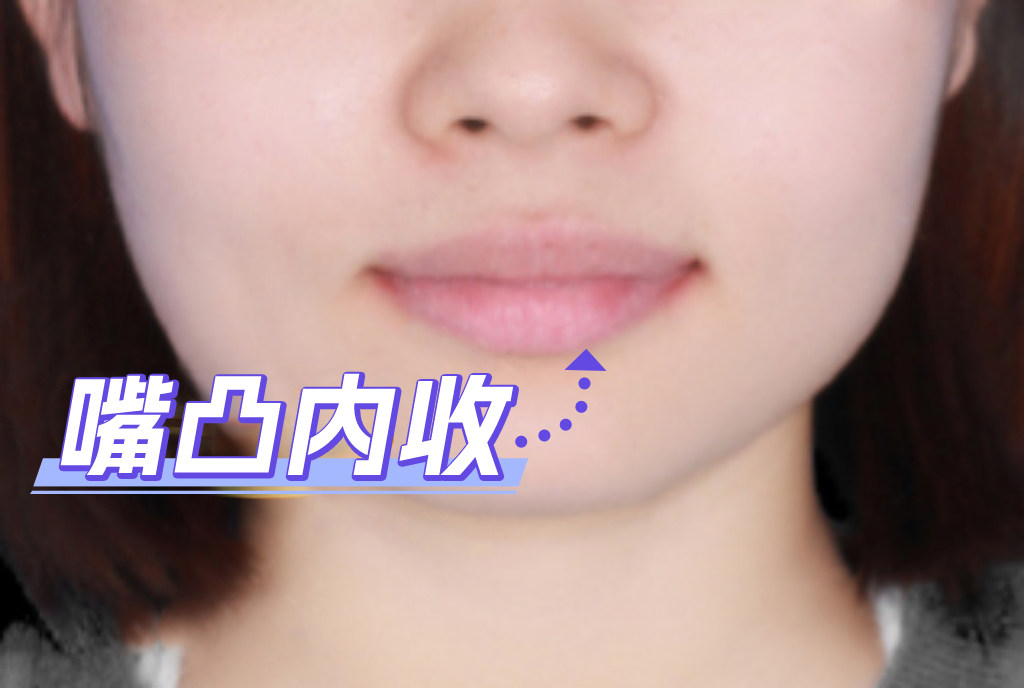 💥从"小凸嘴"到"侧颜杀"！我的正畸逆袭全记录✨