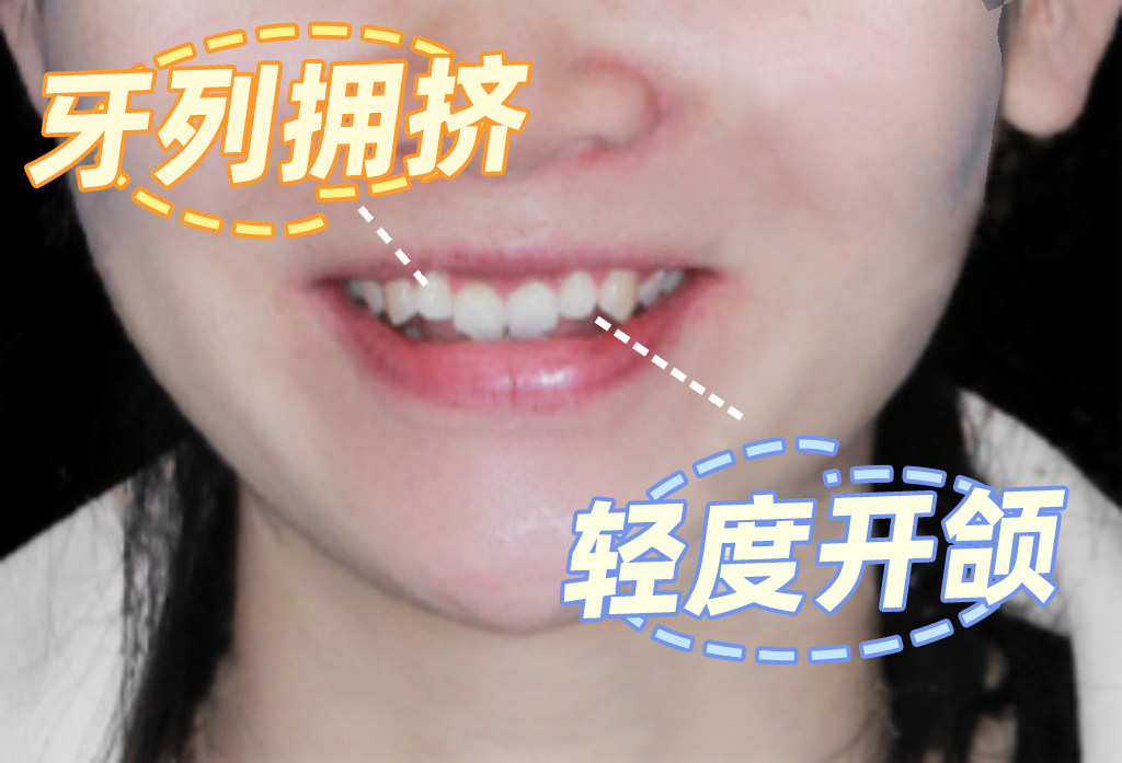 ✨告别开颌+牙齿拥挤！我的正畸经验分享💕案例图片 1