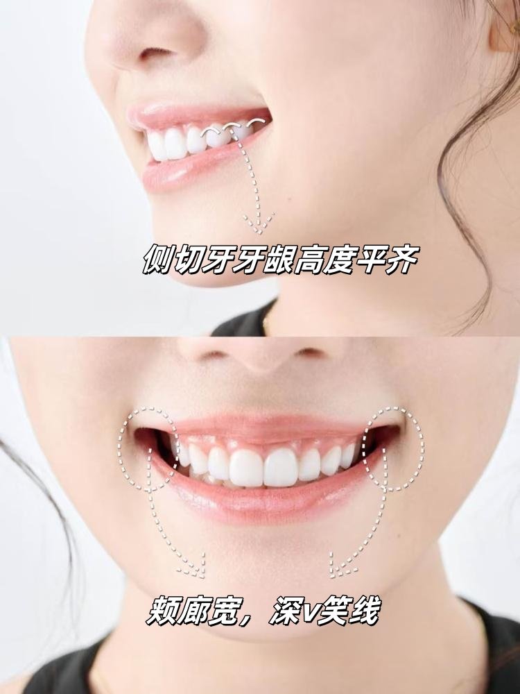 牙贴面一次上岸全攻略｜2w+做不磨牙贴面！避坑必看