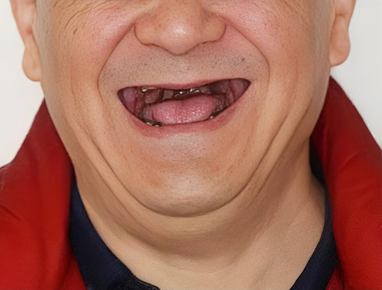 🦷陪父亲种牙全记录｜从抗拒到真香，这个决定我们做对了！案例图片 4