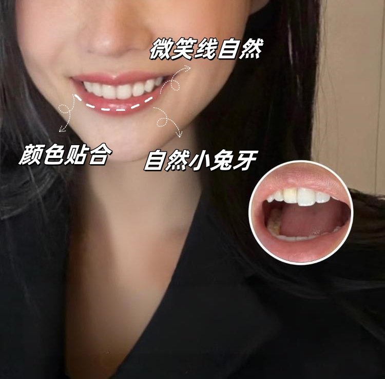 ✨显白牙齿真的会改变气质！我的瓷贴面逆袭史（附干货攻略）