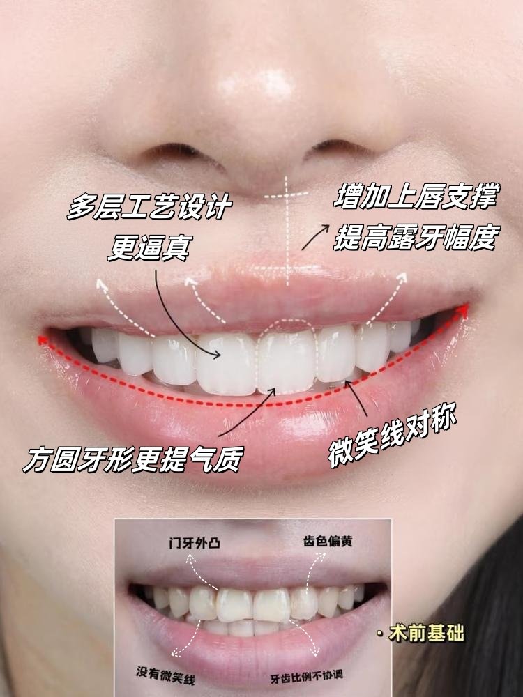 🔥【牙齿贴面界的天花板被我找到了！】姐妹们快看这个微笑作弊神器✨