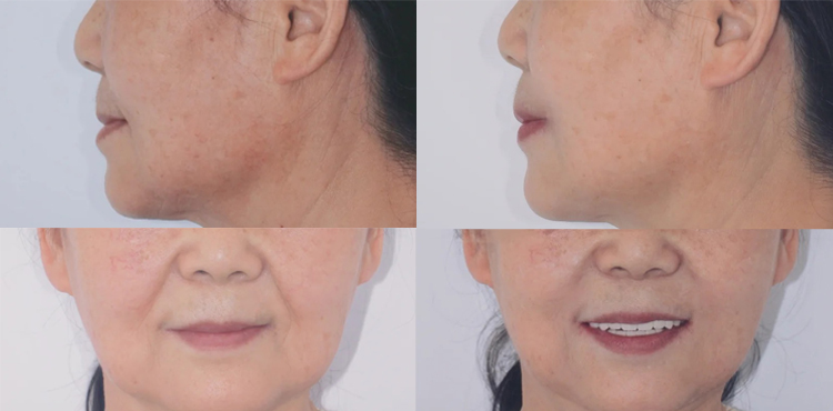 妈妈重获&ldquo;第三副牙齿&rdquo;！种植牙真实经历分享案例图片 2