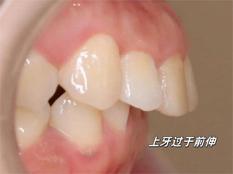 🦷26岁戴牙套被说&ldquo;没必要&rdquo;，现在她们都问我怎么做到的案例图片 3