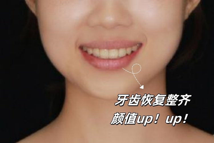 🦷牙套毕业典礼！嘴凸女孩的逆袭日记
