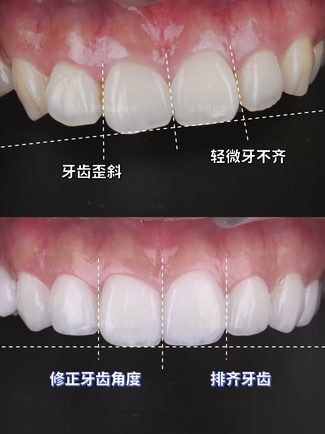 从&ldquo;蝴蝶牙&rdquo;到微笑杀！整牙堪比换头术！🦋案例图片 2