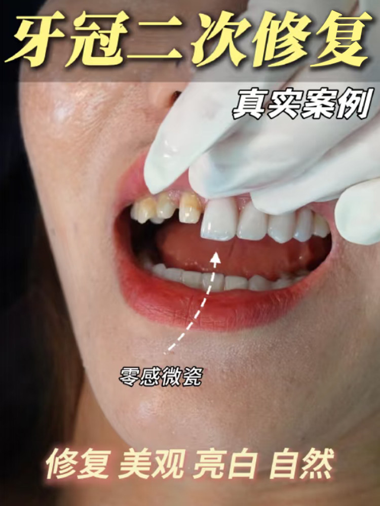 牙齿复活术，全瓷贴面直接get你的原生牙案例图片 1