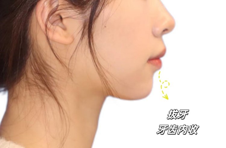 从"钢牙妹"到"隐形美人"｜我的5.8万舌侧矫正血泪史案例图片 4
