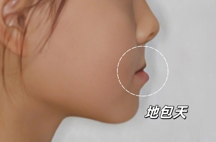 👧🏻姐姐的碎碎念｜12岁妹妹反颌矫正全记录：抓住黄金期真的事半功倍！案例图片 2