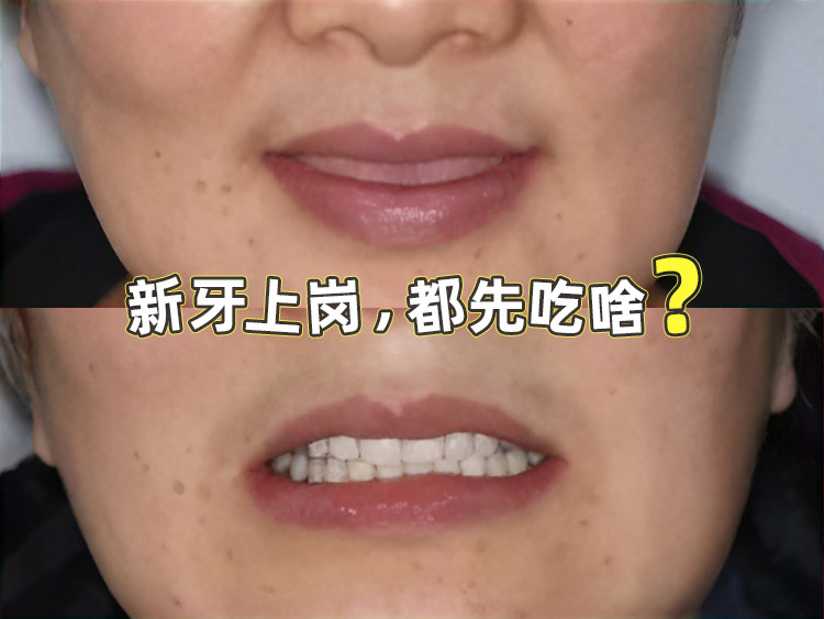 新牙上岗，先宠幸谁？🦷案例图片 1